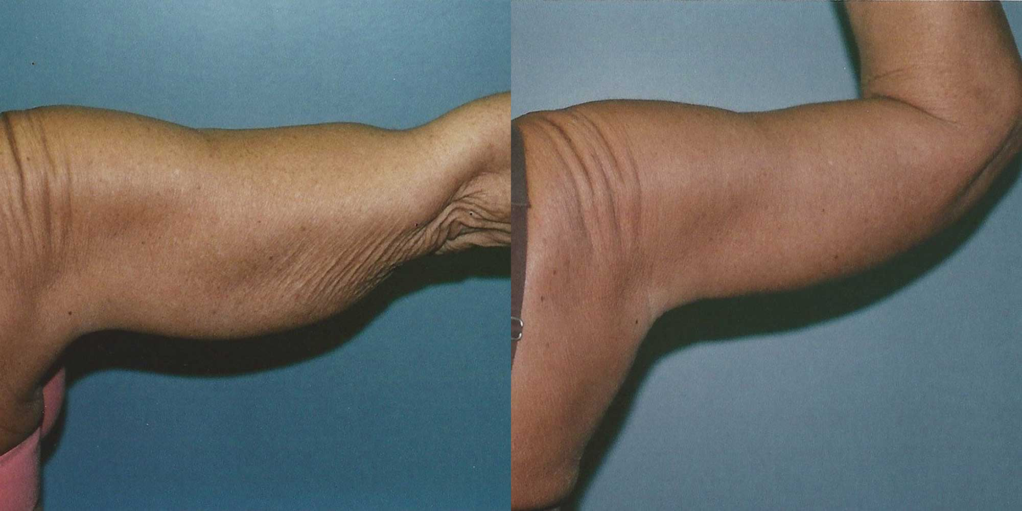 Arm Lift Before and After photo by Douglas Hargrave, MD of The Plastic Surgery Group in Albany, NY