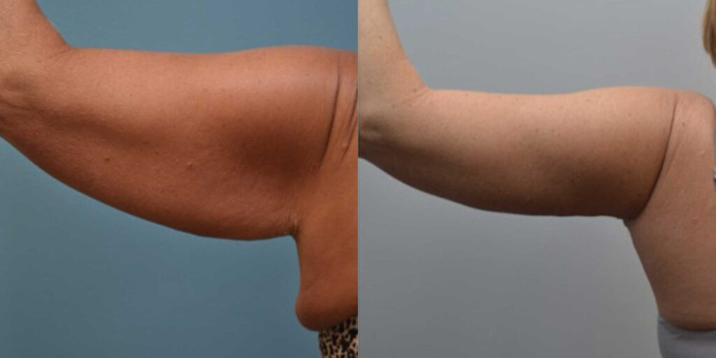 Arm Lift Before and After photo by Douglas Hargrave, MD of The Plastic Surgery Group in Albany, NY