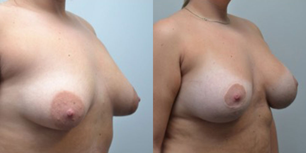 Asymmetric Breasts Before and After photo by Douglas Hargrave, MD of The Plastic Surgery Group in Albany, NY