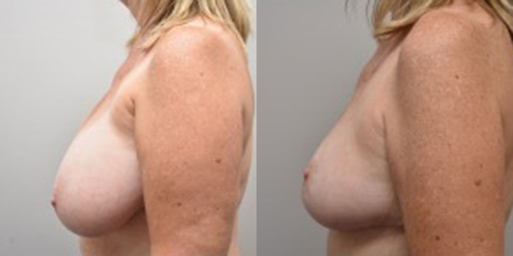 Asymmetric Breasts Before and After photo by Susan Gannon, MD of The Plastic Surgery Group in Albany, NY