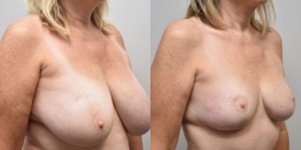 Asymmetric Breasts Before and After photo by Susan Gannon, MD of The Plastic Surgery Group in Albany, NY