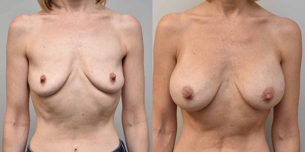 Breast Augmentation Before and After photo by Douglas Hargrave, MD of The Plastic Surgery Group in Albany, NY