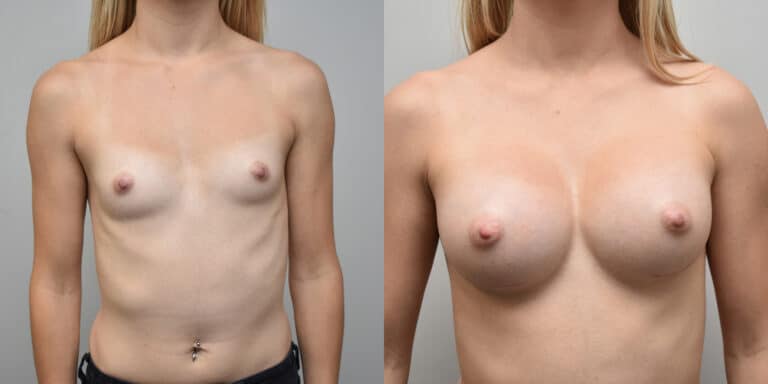 Breast Augmentation Before and After photo by Susan Gannon, MD of The Plastic Surgery Group in Albany, NY Breast Augmentation Before and After photo by Susan Gannon, MD of The Plastic Surgery Group in Albany, NY