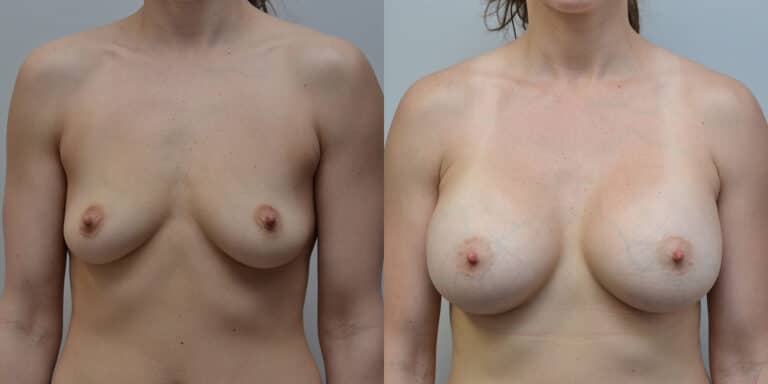 Breast Augmentation Before and After photo by Susan Gannon, MD of The Plastic Surgery Group in Albany, NY Breast Augmentation Before and After photo by Susan Gannon, MD of The Plastic Surgery Group in Albany, NY