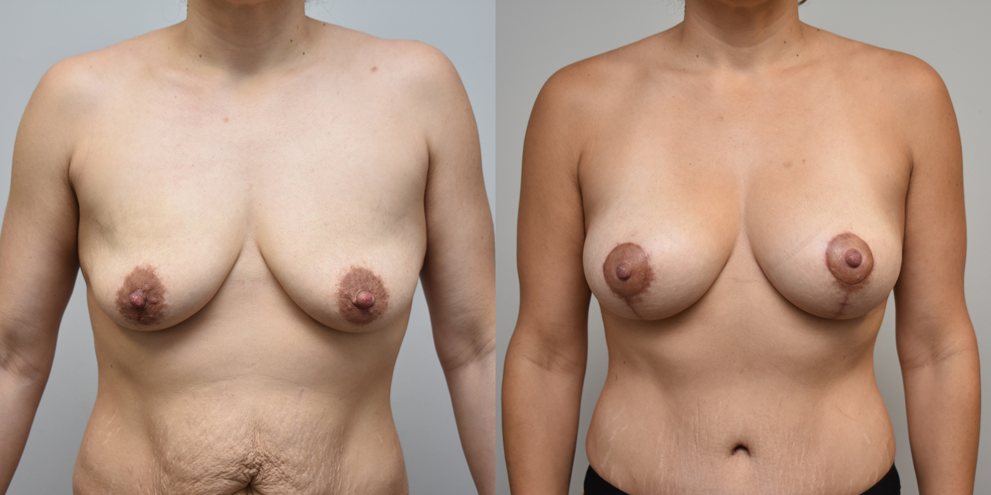 Breast Augmentation Before and After photo by Susan Gannon, MD of The Plastic Surgery Group in Albany, NY