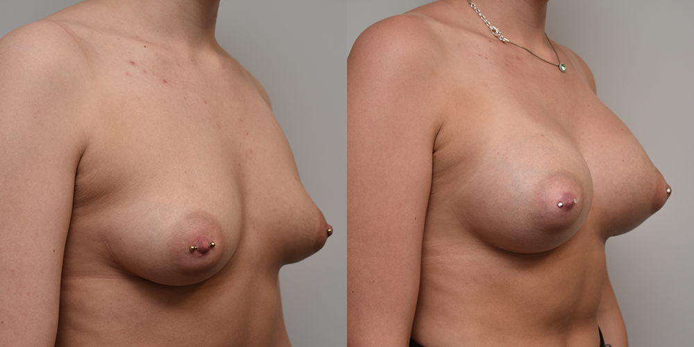 Breast Augmentation Before and After photo by Susan Gannon, MD of The Plastic Surgery Group in Albany, NY