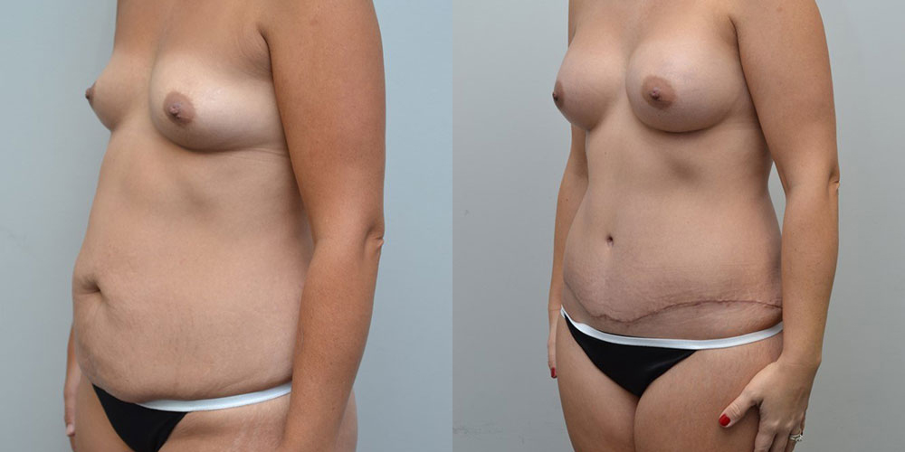 Breast Implants Before and After photo by Douglas Hargrave, MD of The Plastic Surgery Group in Albany, NY