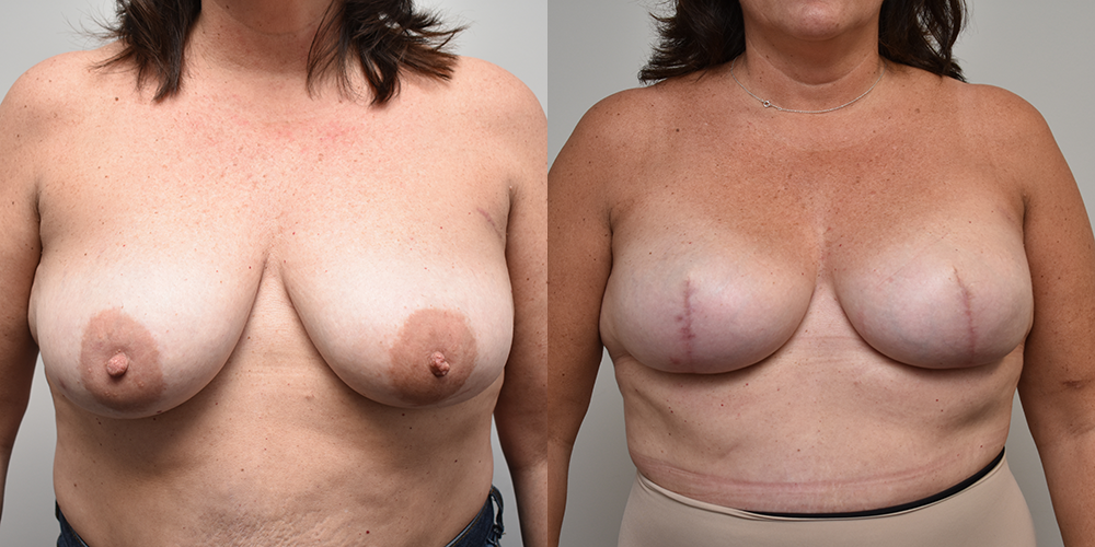Breast Implants Before and After photo by Douglas Hargrave, MD of The Plastic Surgery Group in Albany, NY