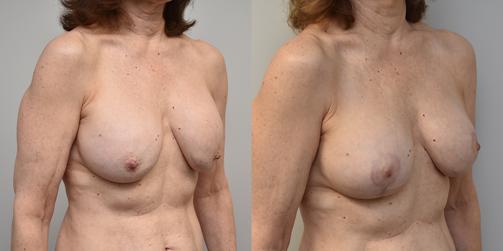 Breast Lift Before and After photo by Douglas Hargrave, MD of The Plastic Surgery Group in Albany, NY