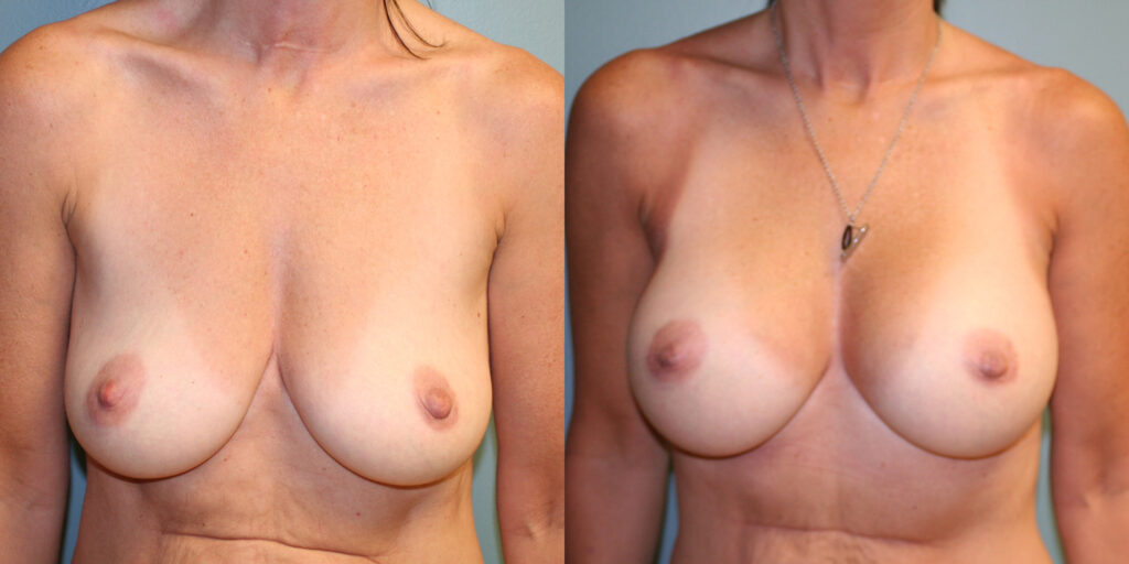 Breast Implants Before and After photo by Susan Gannon, MD of The Plastic Surgery Group in Albany, NY