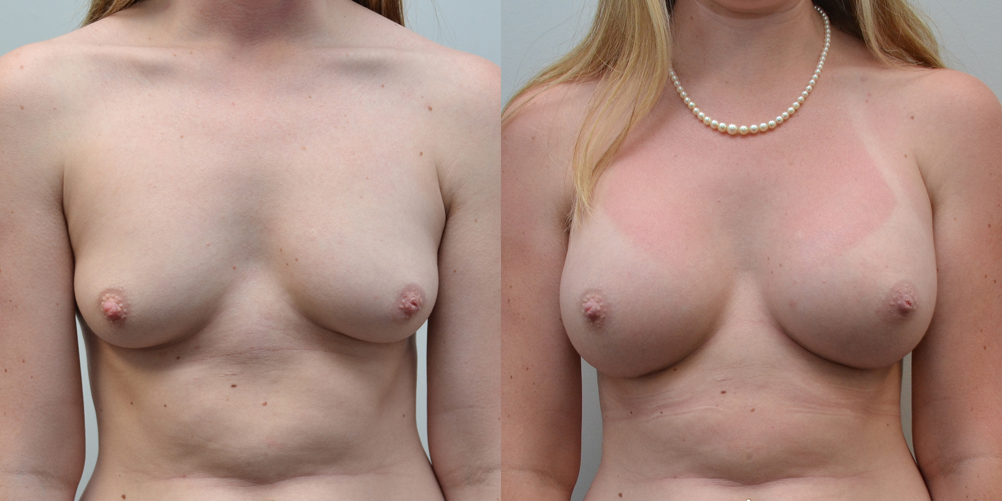 Breast Implants Before and After photo by Susan Gannon, MD of The Plastic Surgery Group in Albany, NY