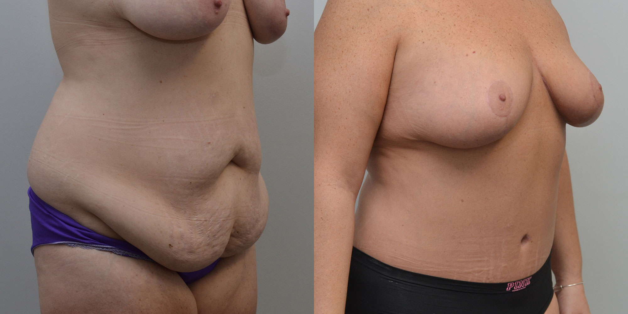 Breast Lift Before and After photo by Susan Gannon, MD of The Plastic Surgery Group in Albany, NY