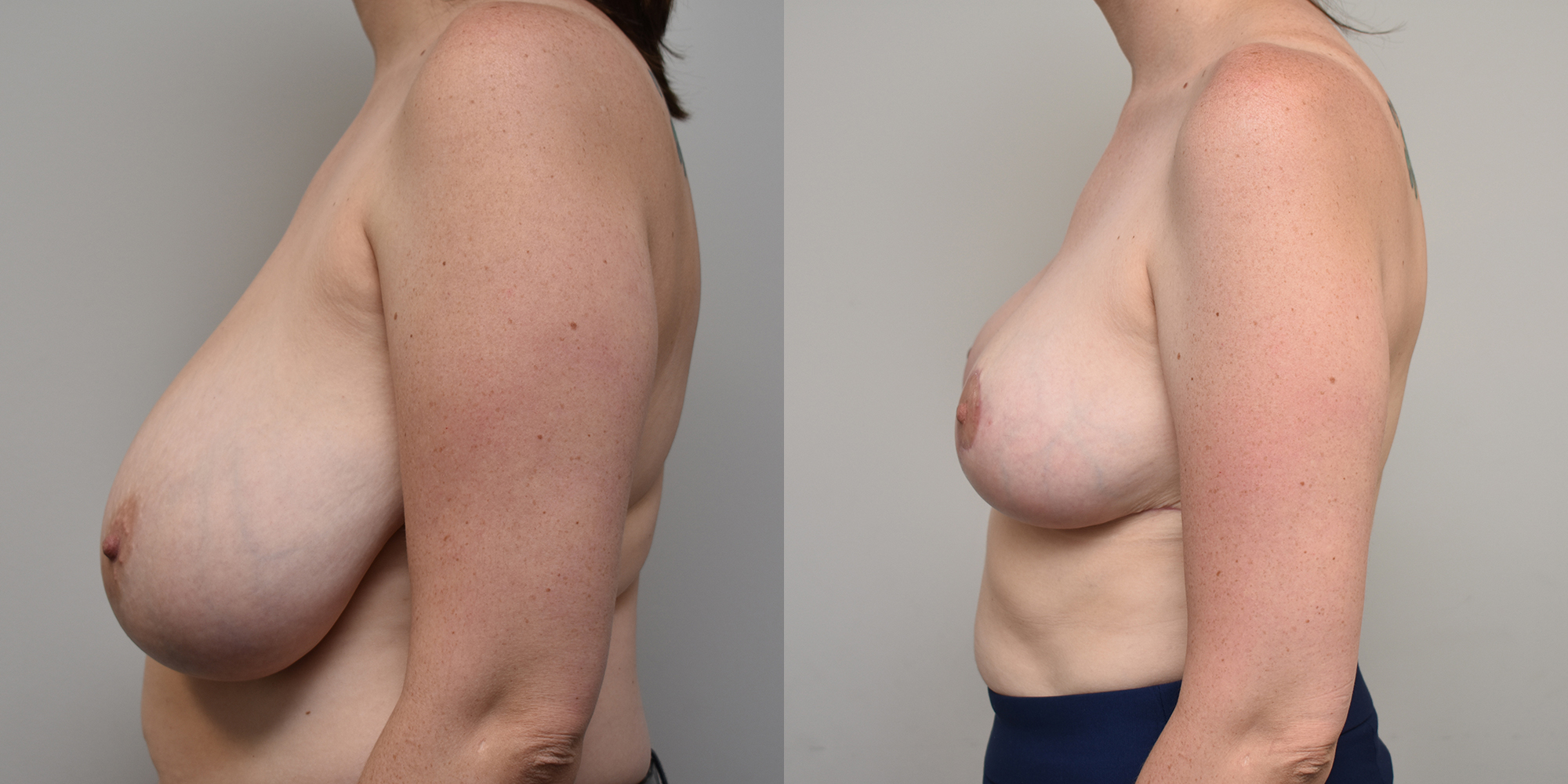 Breast Lift Before and After photo by Susan Gannon, MD of The Plastic Surgery Group in Albany, NY