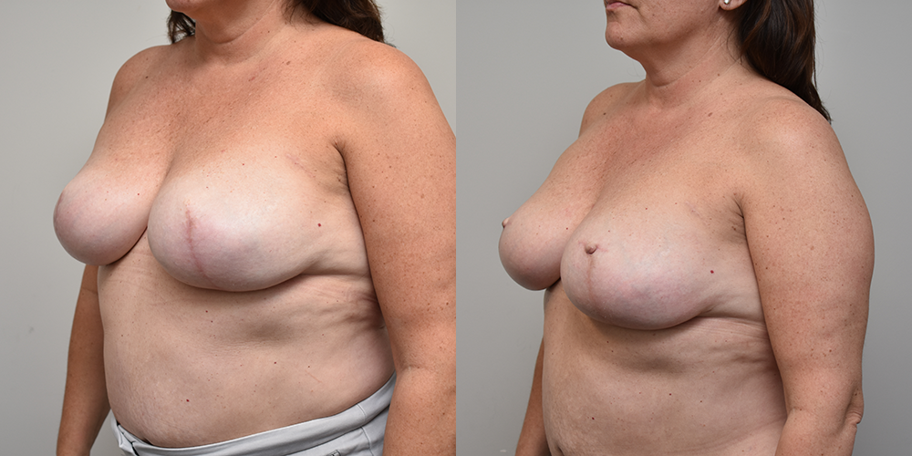 Breast Reconstruction Before and After photo by Douglas Hargrave, MD of The Plastic Surgery Group in Albany, NY