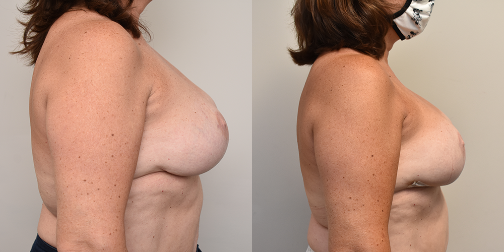 Breast Reconstruction Before and After photo by Douglas Hargrave, MD of The Plastic Surgery Group in Albany, NY