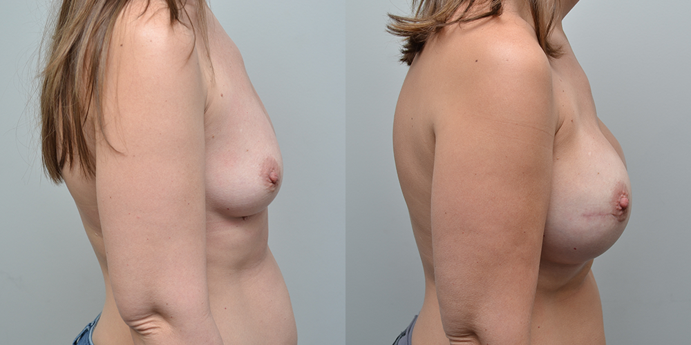 Breast Reconstruction Before and After photo by Susan Gannon, MD of The Plastic Surgery Group in Albany, NY