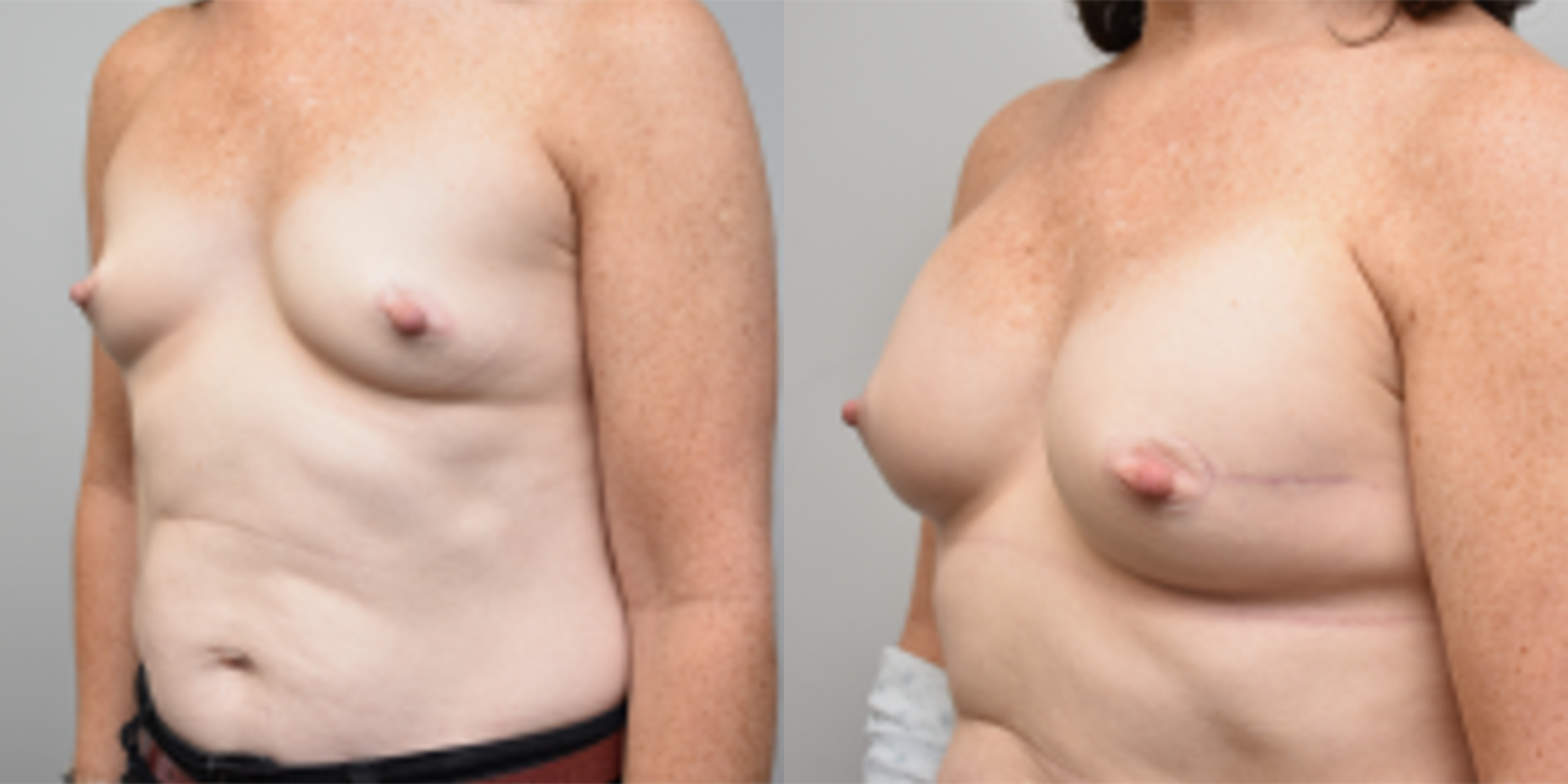 Breast Reconstruction Before and After photo by Susan Gannon, MD of The Plastic Surgery Group in Albany, NY