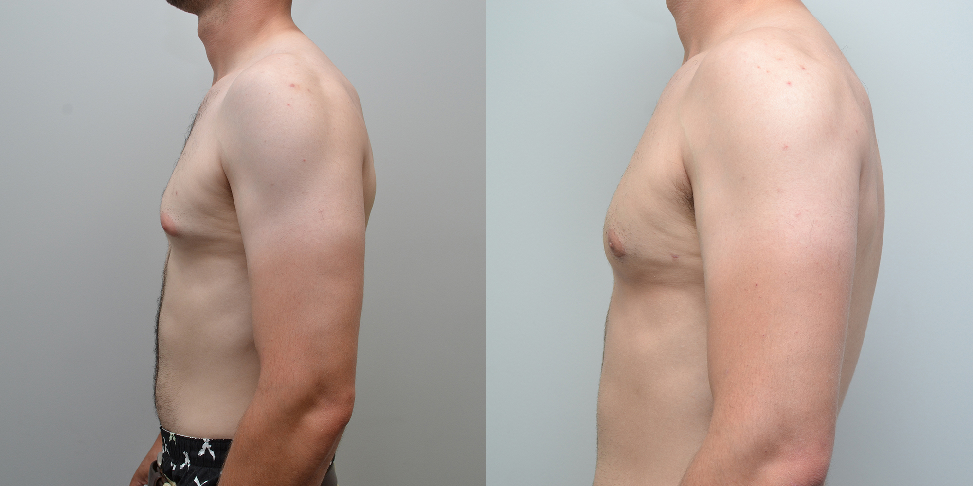 Breast Reduction Before and After photo by Douglas Hargrave, MD of The Plastic Surgery Group in Albany, NY