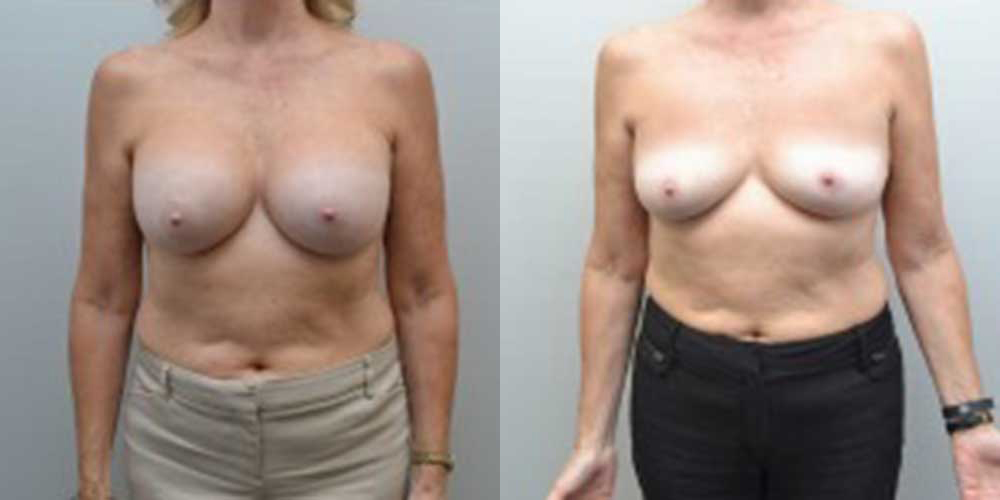 Breast Reduction Before and After photo by Susan Gannon, MD of The Plastic Surgery Group in Albany, NY