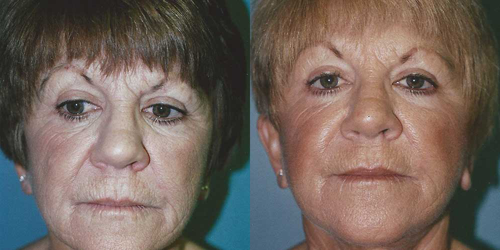 Brow Lift Before and After photo by Douglas Hargrave, MD of The Plastic Surgery Group in Albany, NY