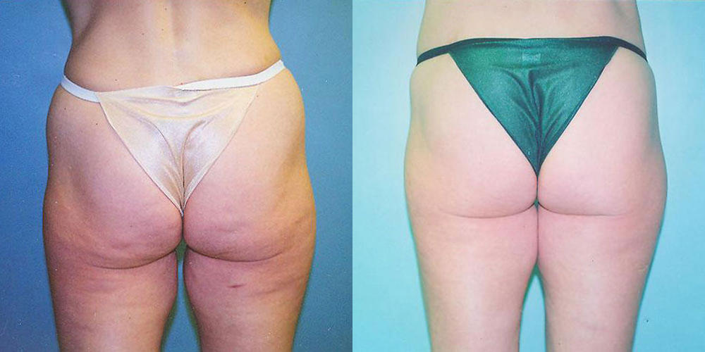 Buttock Lift Before and After photo by Douglas Hargrave, MD of The Plastic Surgery Group in Albany, NY