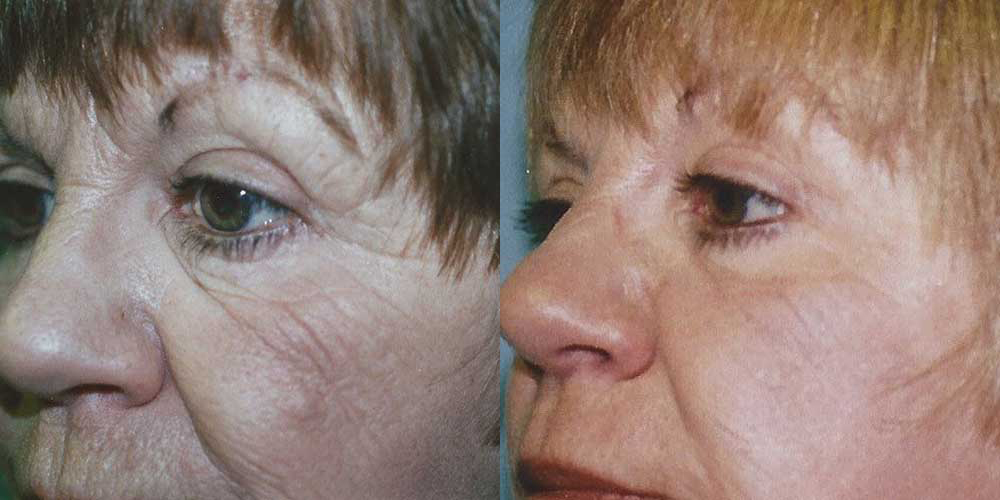 Eyelid Surgery Before and After photo by Douglas Hargrave, MD of The Plastic Surgery Group in Albany, NY