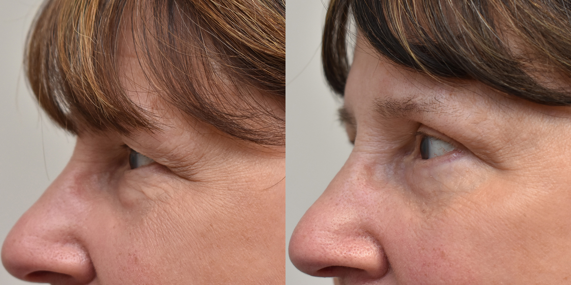 Eyelid Surgery Before and After photo by Susan Gannon, MD of The Plastic Surgery Group in Albany, NY