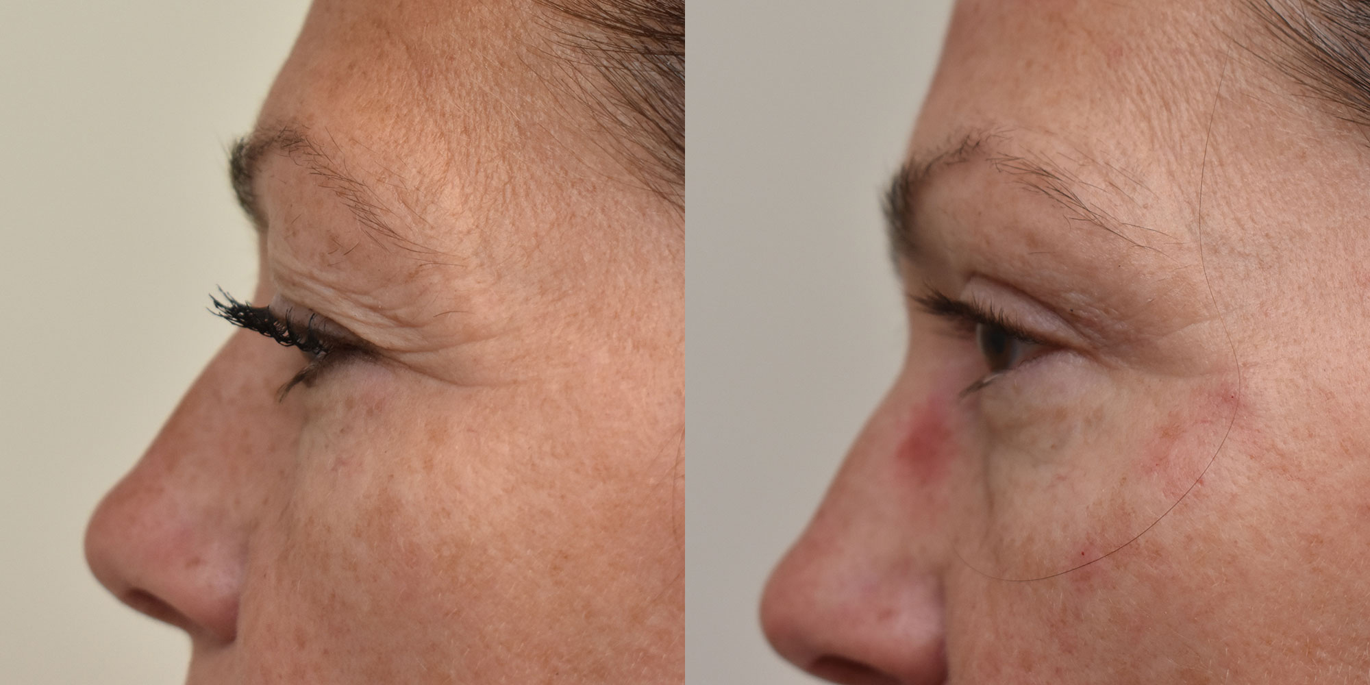 Eyelid Surgery Before and After photo by Susan Gannon, MD of The Plastic Surgery Group in Albany, NY
