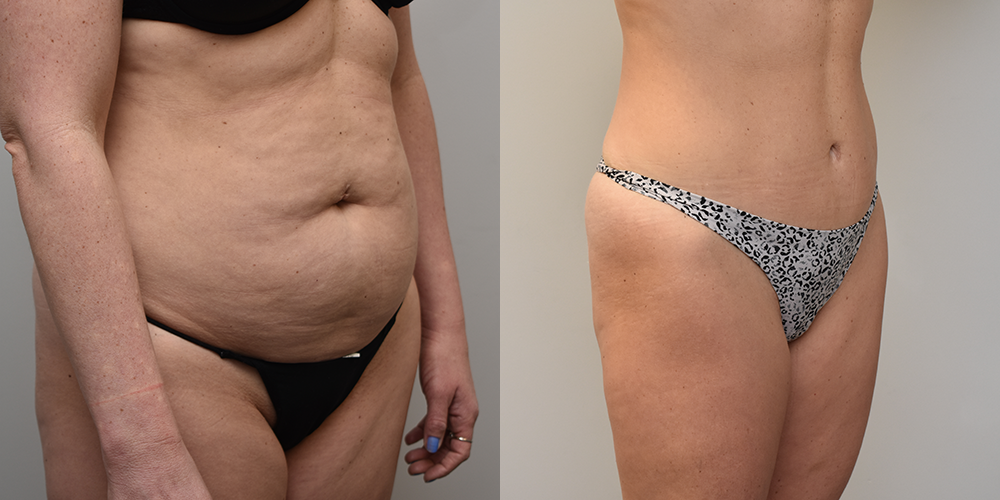 Liposuction Before and After photo by Douglas Hargrave, MD of The Plastic Surgery Group in Albany, NY