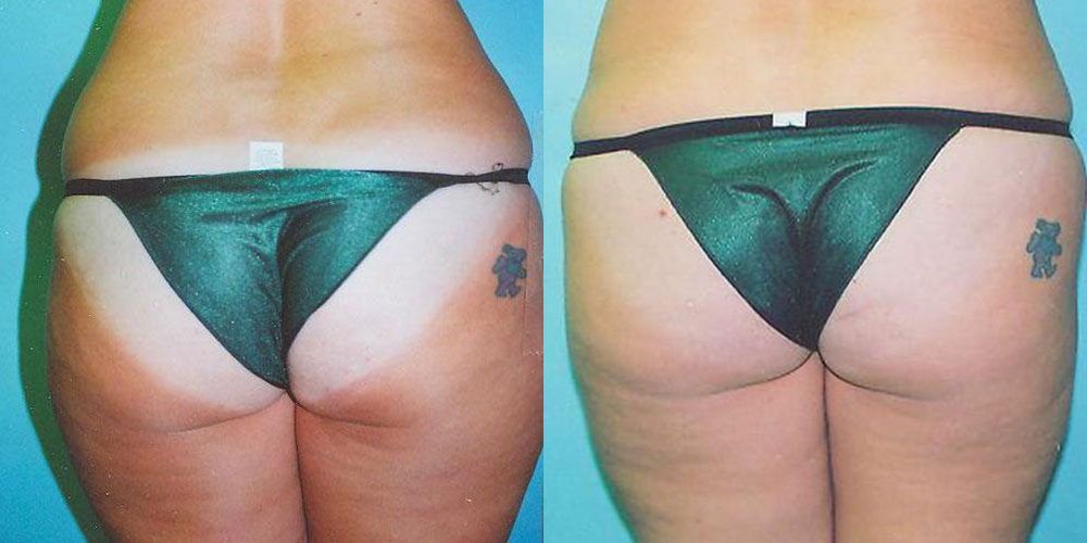 Liposuction Before and After photo by Douglas Hargrave, MD of The Plastic Surgery Group in Albany, NY
