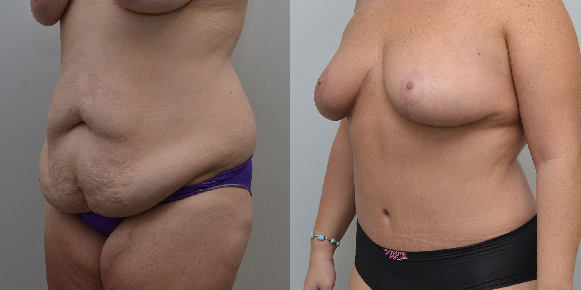Liposuction Before and After photo by Susan Gannon, MD of The Plastic Surgery Group in Albany, NY