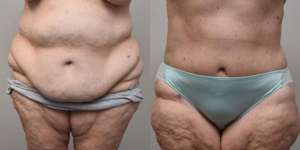 Liposuction Before and After photo by Susan Gannon, MD of The Plastic Surgery Group in Albany, NY