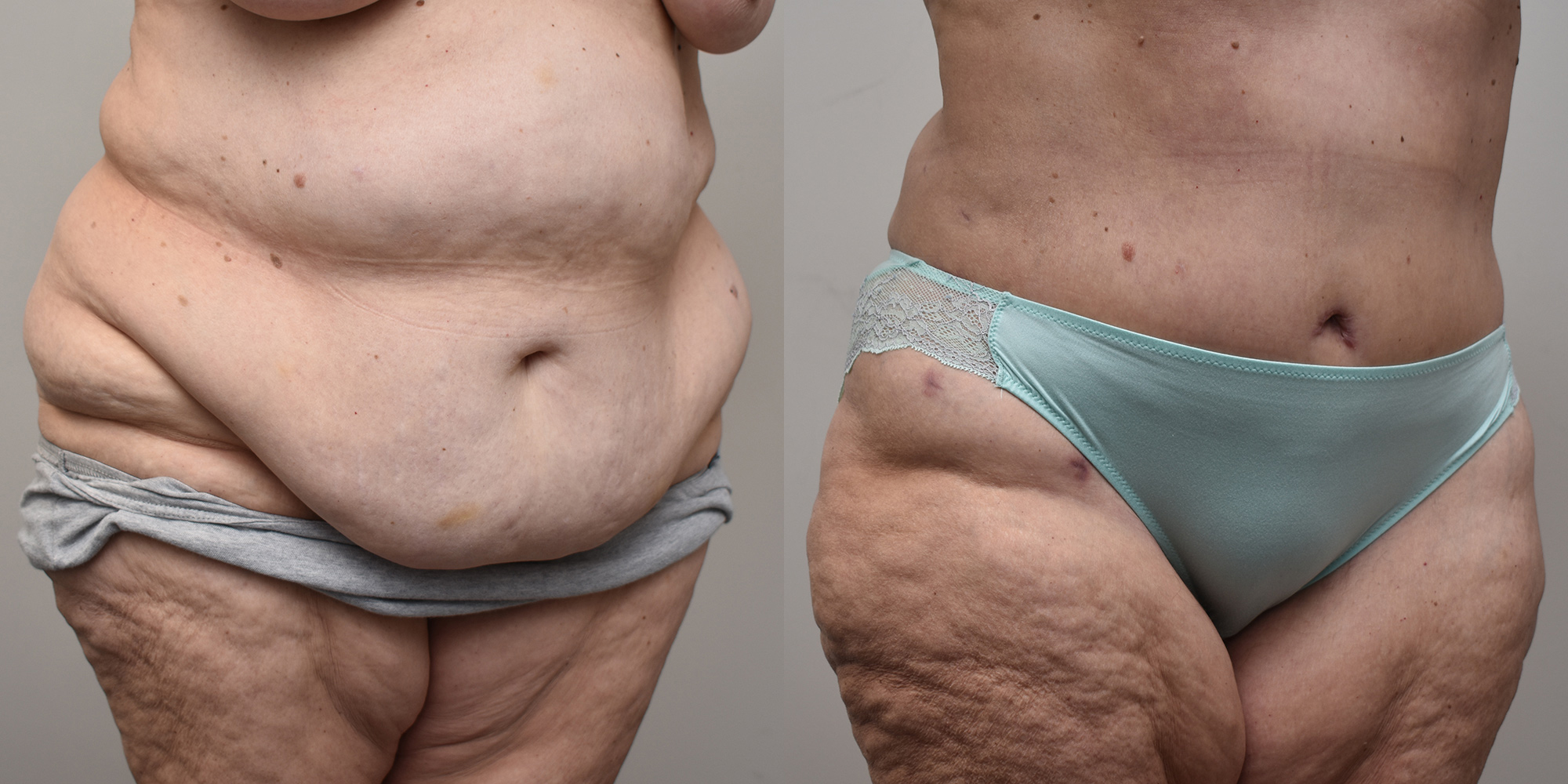 Liposuction Before and After photo by Susan Gannon, MD of The Plastic Surgery Group in Albany, NY