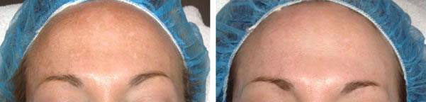 Microneedling Before and After photo by The Plastic Surgery Group in Albany, NY