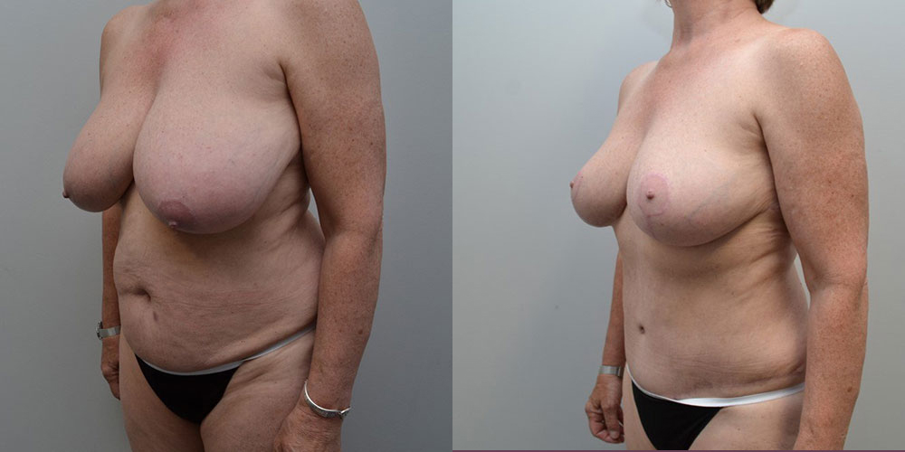 Mommy Makeover Before and After photo by Douglas Hargrave, MD of The Plastic Surgery Group in Albany, NY
