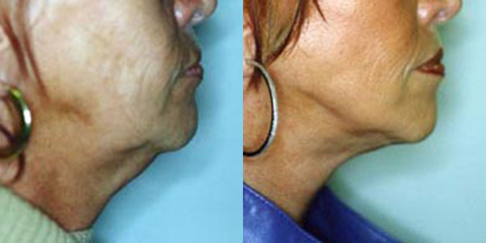 Neck Lift Before and After photo by Douglas Hargrave, MD of The Plastic Surgery Group in Albany, NY
