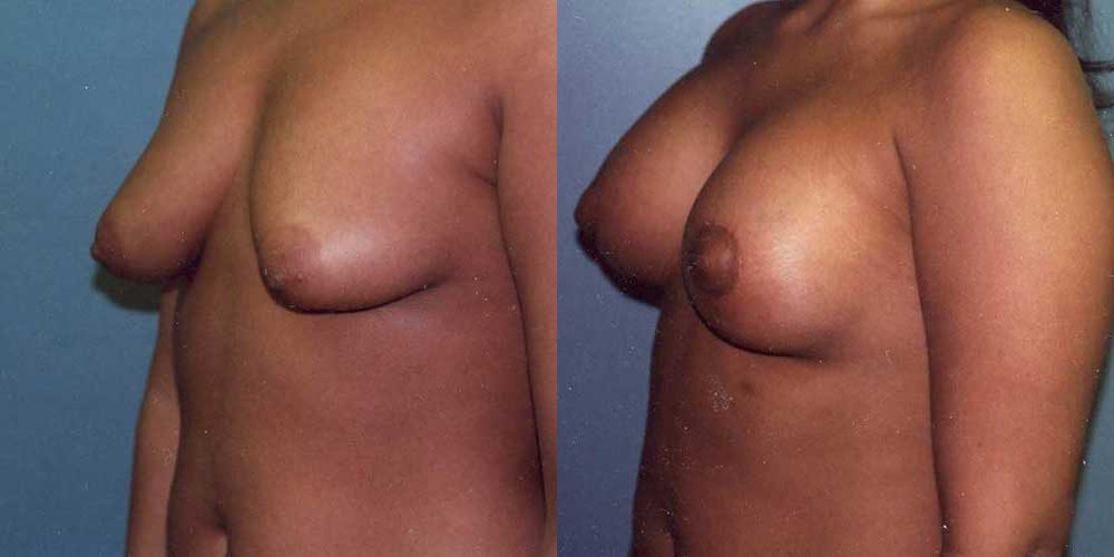 Tubular Breasts Before and After photo by Douglas Hargrave, MD of The Plastic Surgery Group in Albany, NY