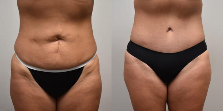 Tummy Tuck Before and After photo by Susan Gannon, MD of The Plastic Surgery Group in Albany, NY Tummy Tuck Before and After photo by Susan Gannon, MD of The Plastic Surgery Group in Albany, NY