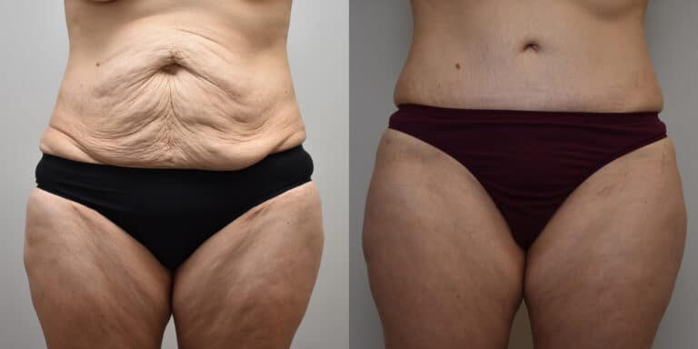 Tummy Tuck Before and After photo by Susan Gannon, MD of The Plastic Surgery Group in Albany, NY Tummy Tuck Before and After photo by Susan Gannon, MD of The Plastic Surgery Group in Albany, NY