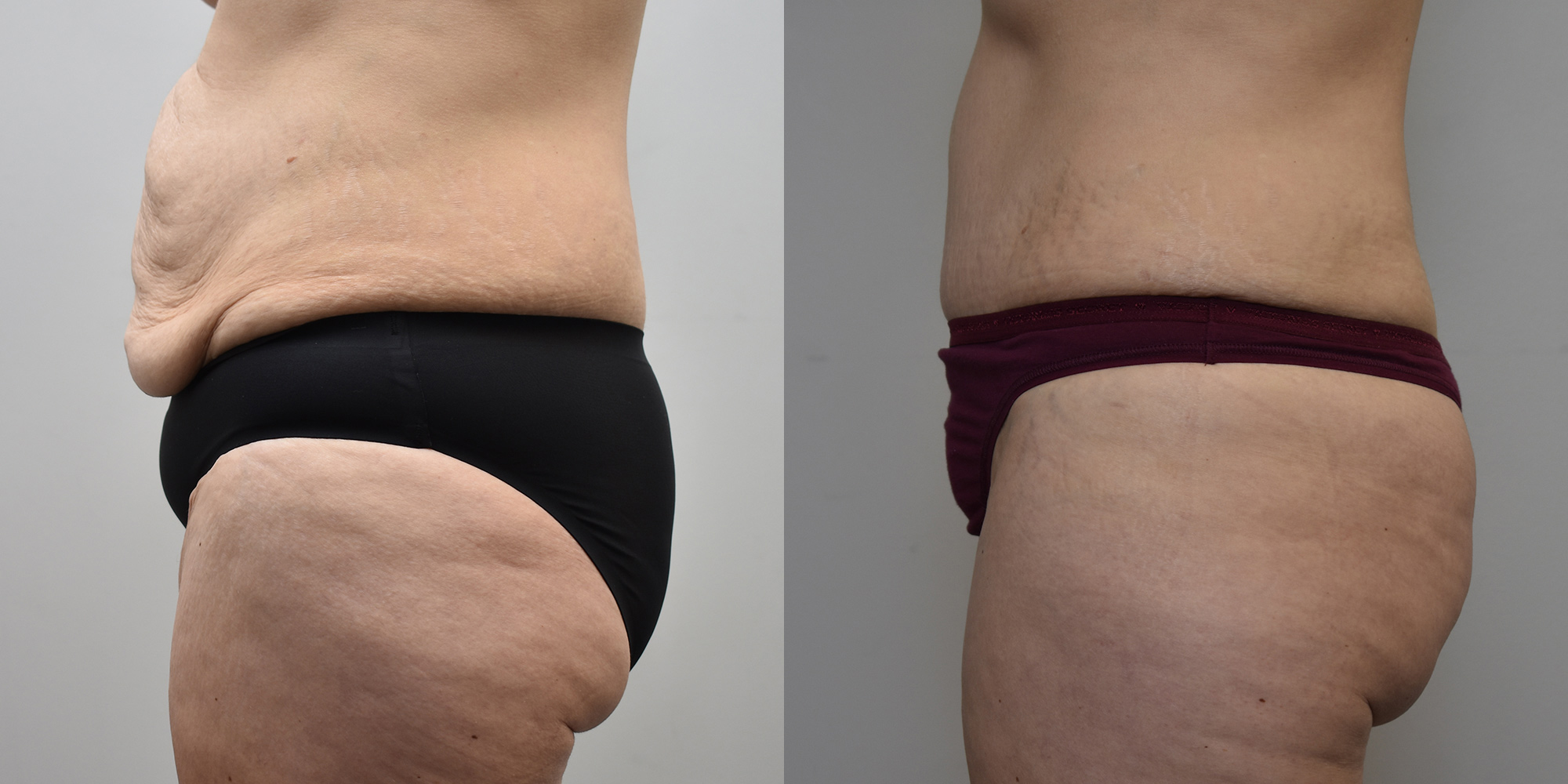 Tummy Tuck Before and After photo by Susan Gannon, MD of The Plastic Surgery Group in Albany, NY