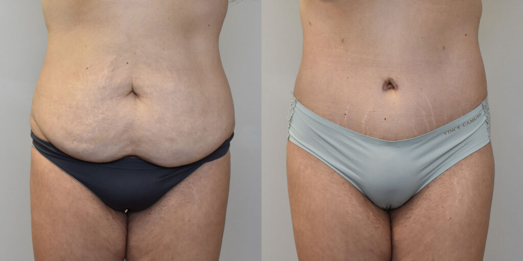 Tummy Tuck Before and After photo by Susan Gannon, MD of The Plastic Surgery Group in Albany, NY