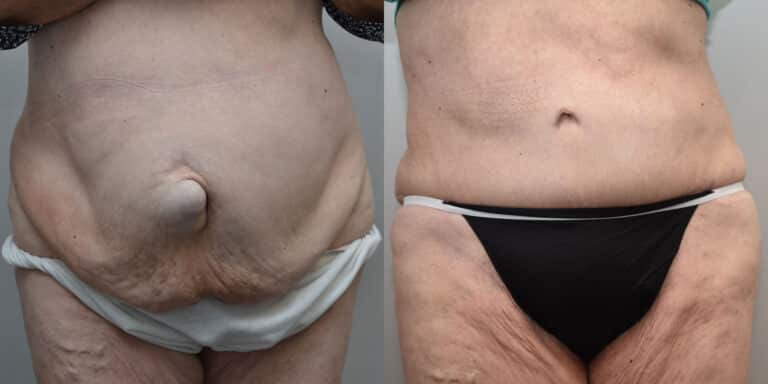 Tummy Tuck Before and After photo by Susan Gannon, MD of The Plastic Surgery Group in Albany, NY Tummy Tuck Before and After photo by Susan Gannon, MD of The Plastic Surgery Group in Albany, NY