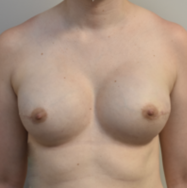 Breast Implants Before and After photo
