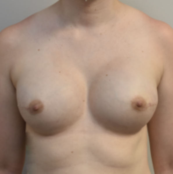 Breast Implants Before and After photo Breast Implants Before and After photo