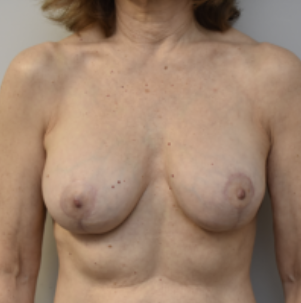 Breast Lift Before and After photo by Douglas Hargrave, MD of The Plastic Surgery Group in Albany, NY