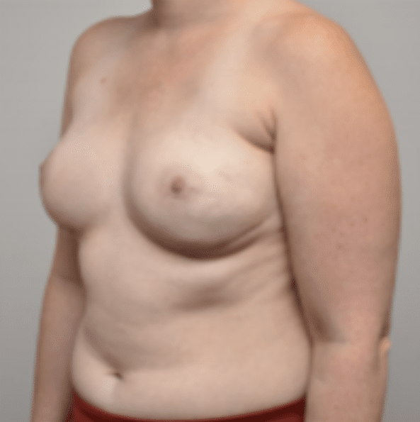 Breast Reconstruction Before and After photo by Susan Gannon, MD of The Plastic Surgery Group in Albany, NY