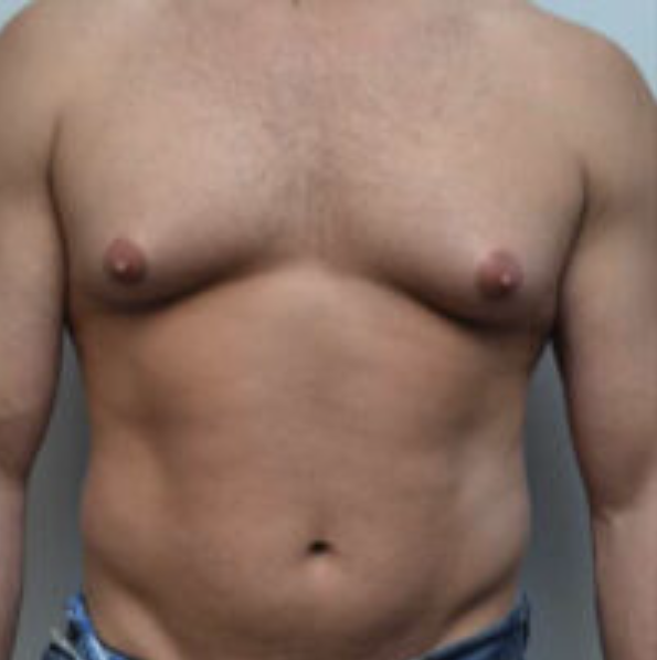 Breast Reduction Before and After photo by Douglas Hargrave, MD of The Plastic Surgery Group in Albany, NY