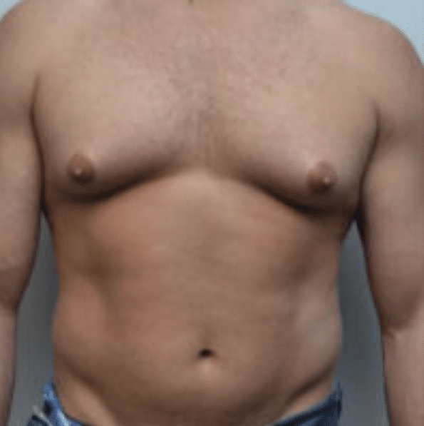 Breast Reduction Before and After photo by Douglas Hargrave, MD of The Plastic Surgery Group in Albany, NY Breast Reduction Before and After photo by Douglas Hargrave, MD of The Plastic Surgery Group in Albany, NY