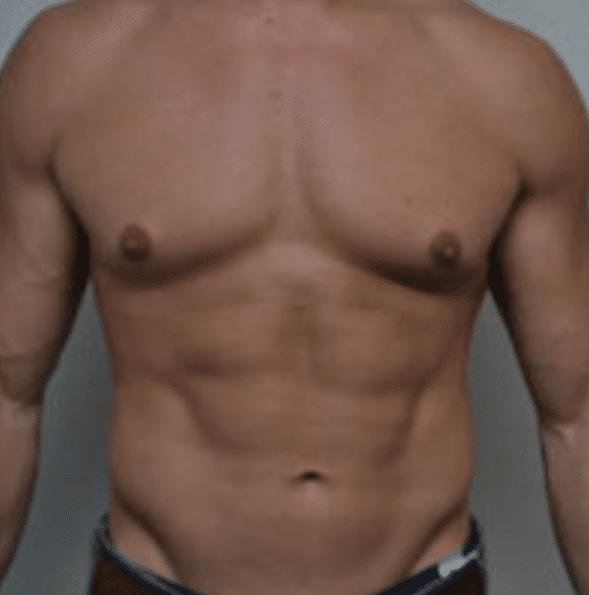 Breast Reduction Before and After photo by Douglas Hargrave, MD of The Plastic Surgery Group in Albany, NY Breast Reduction Before and After photo by Douglas Hargrave, MD of The Plastic Surgery Group in Albany, NY