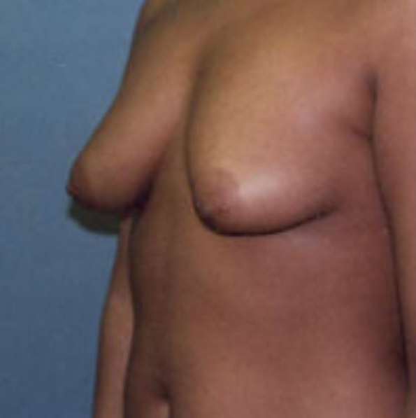 Tubular Breasts Before and After photo by Douglas Hargrave, MD of The Plastic Surgery Group in Albany, NY